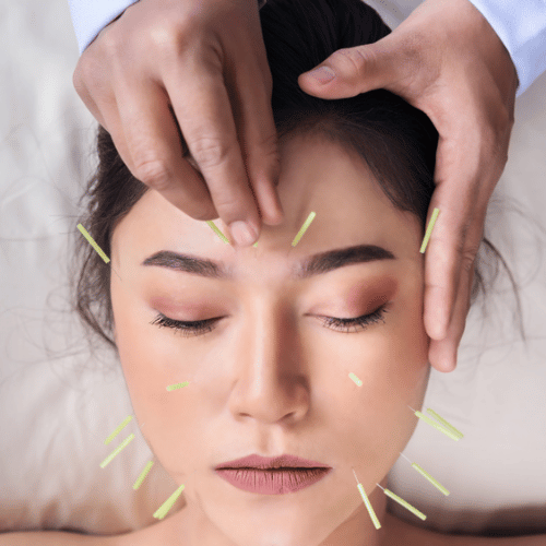 Acupuncture For Sleep: Does It Help With Insomnia